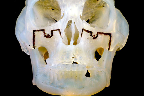 hyperdontia skull
